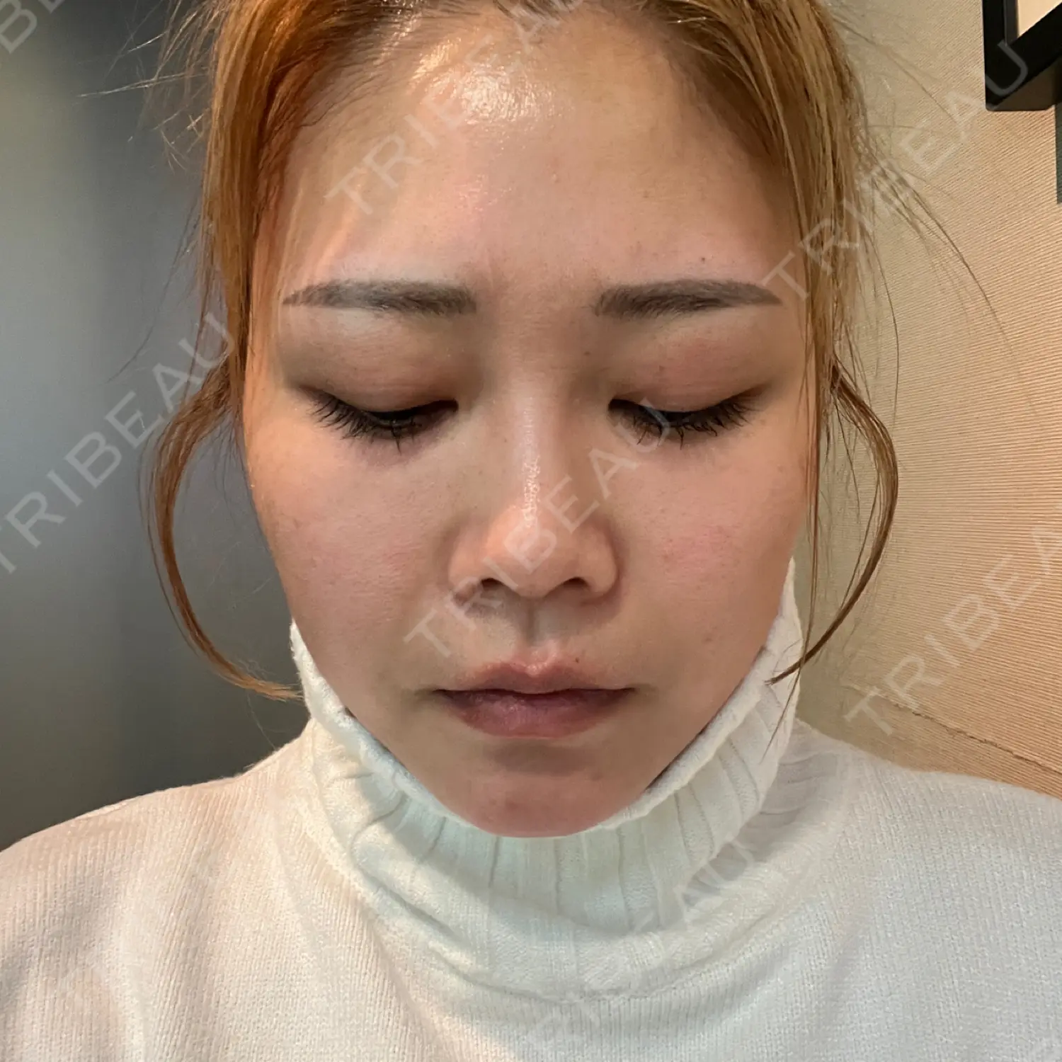 施術前の写真