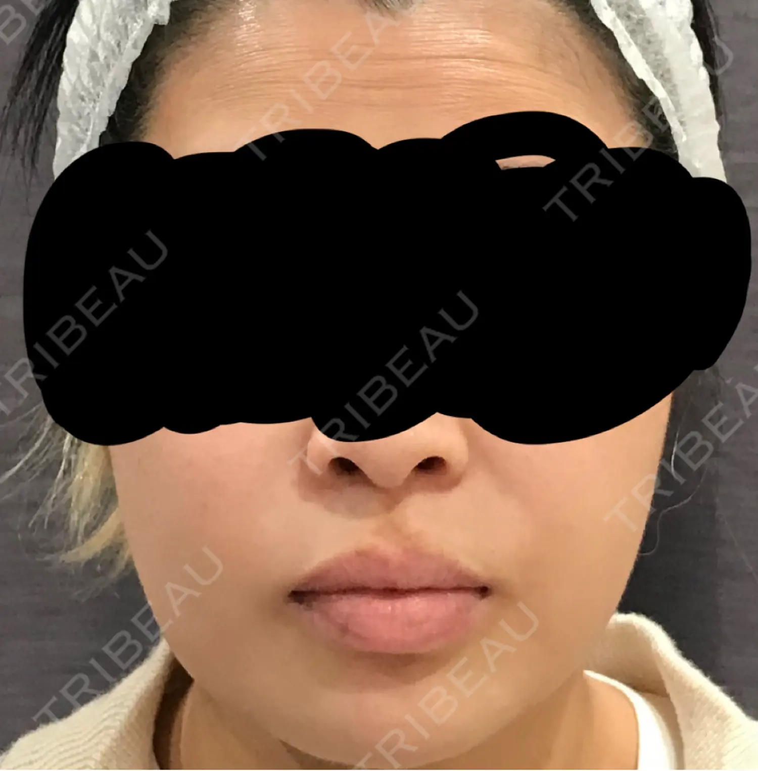 施術前の写真