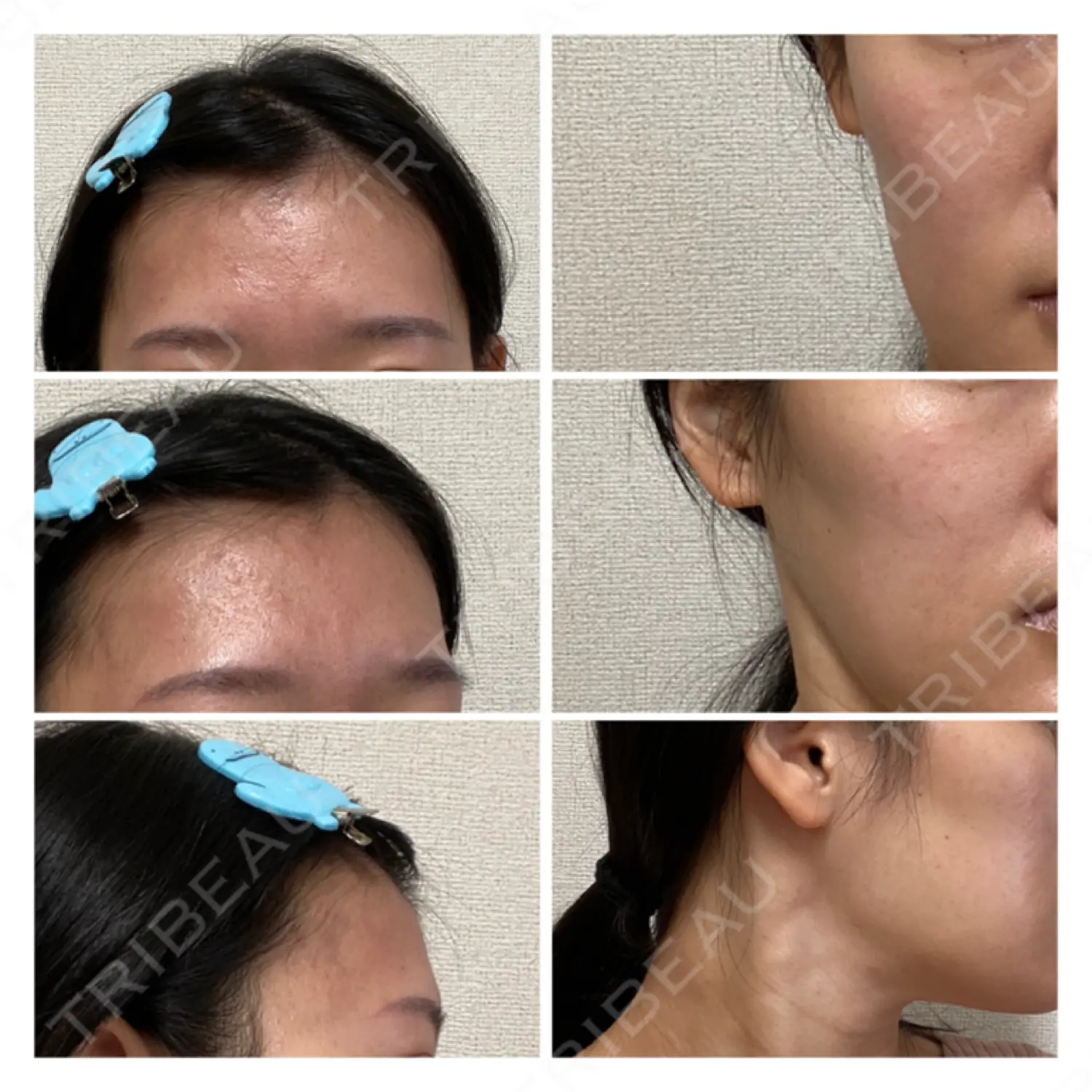 施術前の写真