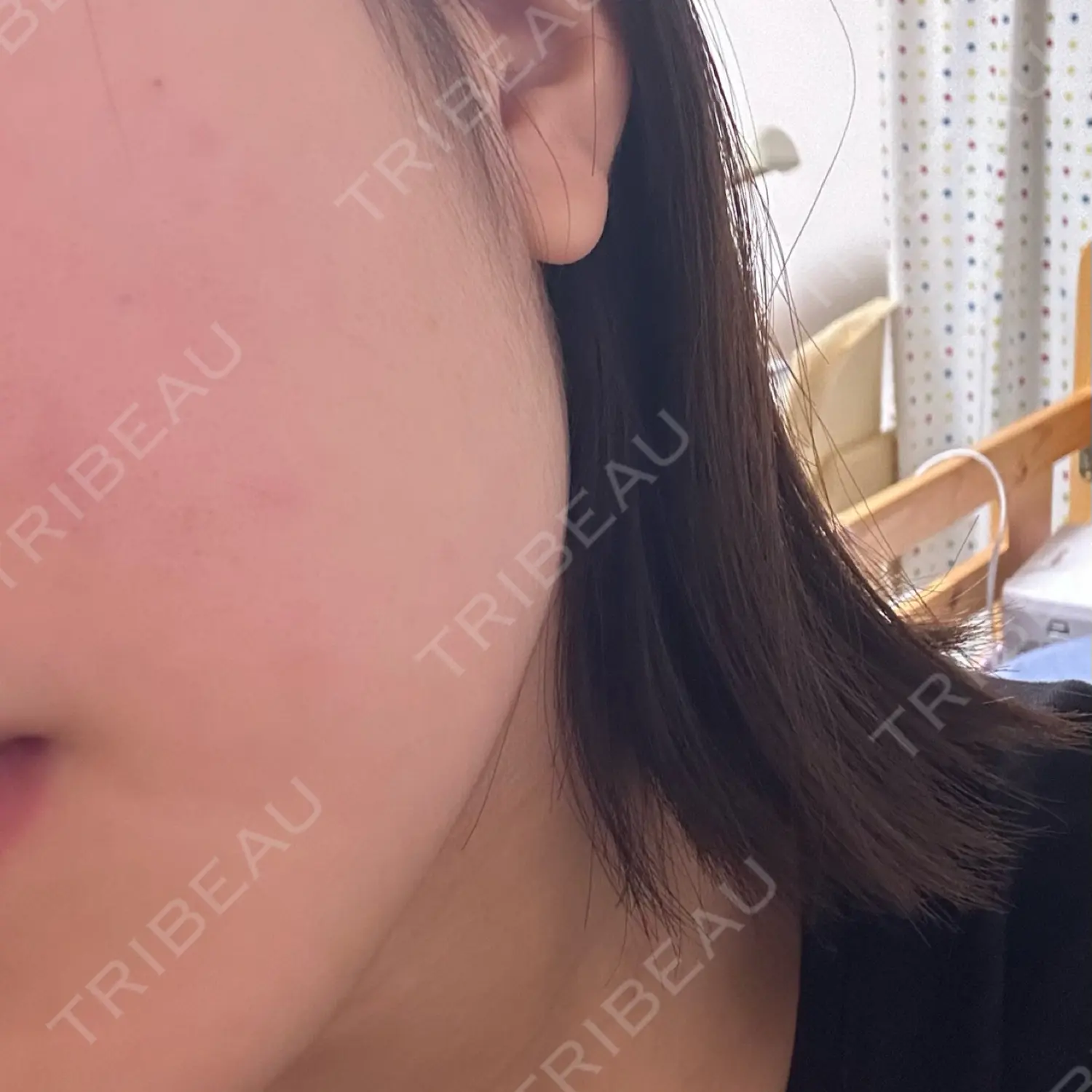 施術前の写真