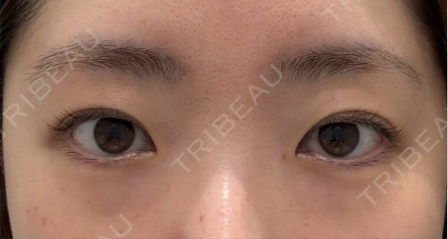 施術前の写真