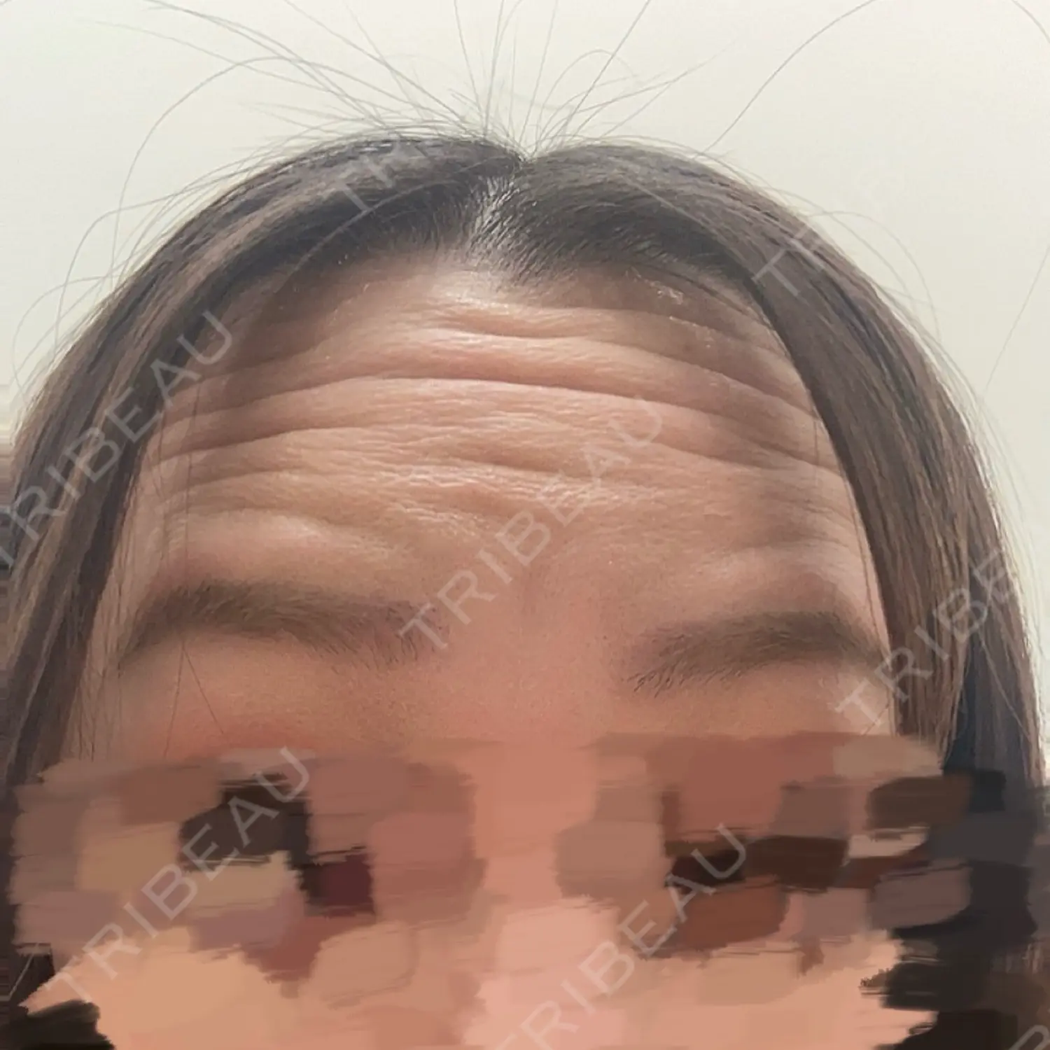 施術前の写真