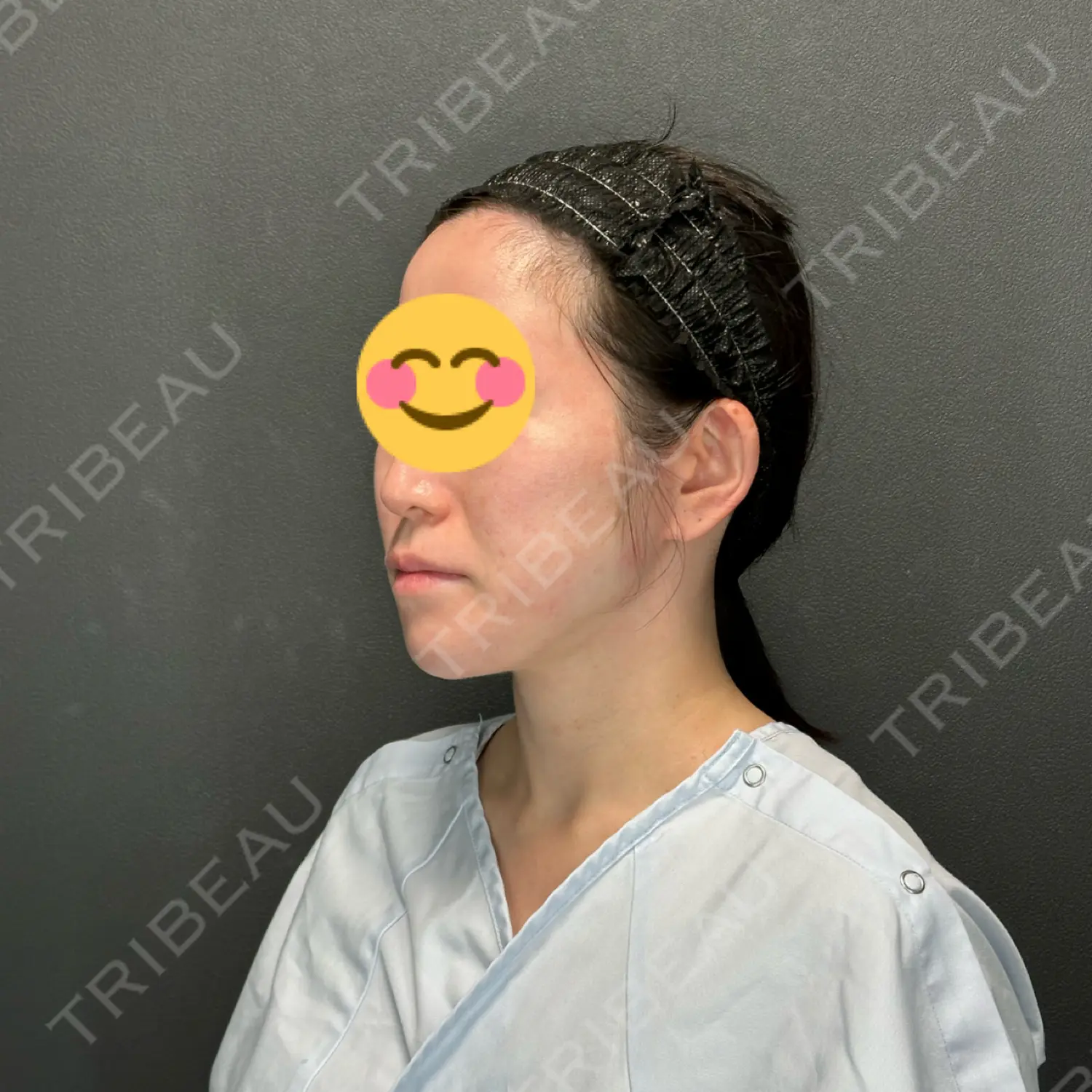 施術前の写真