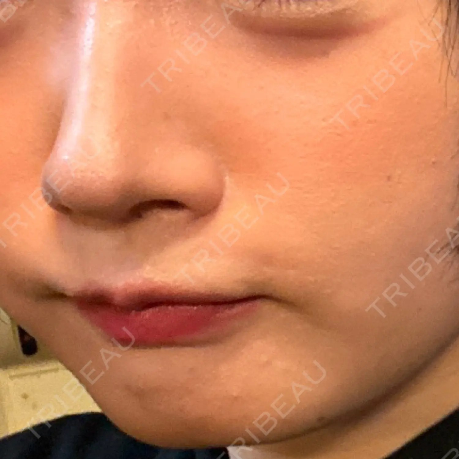 施術前の写真