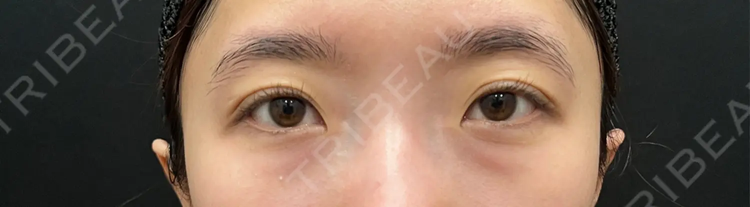 施術前の写真
