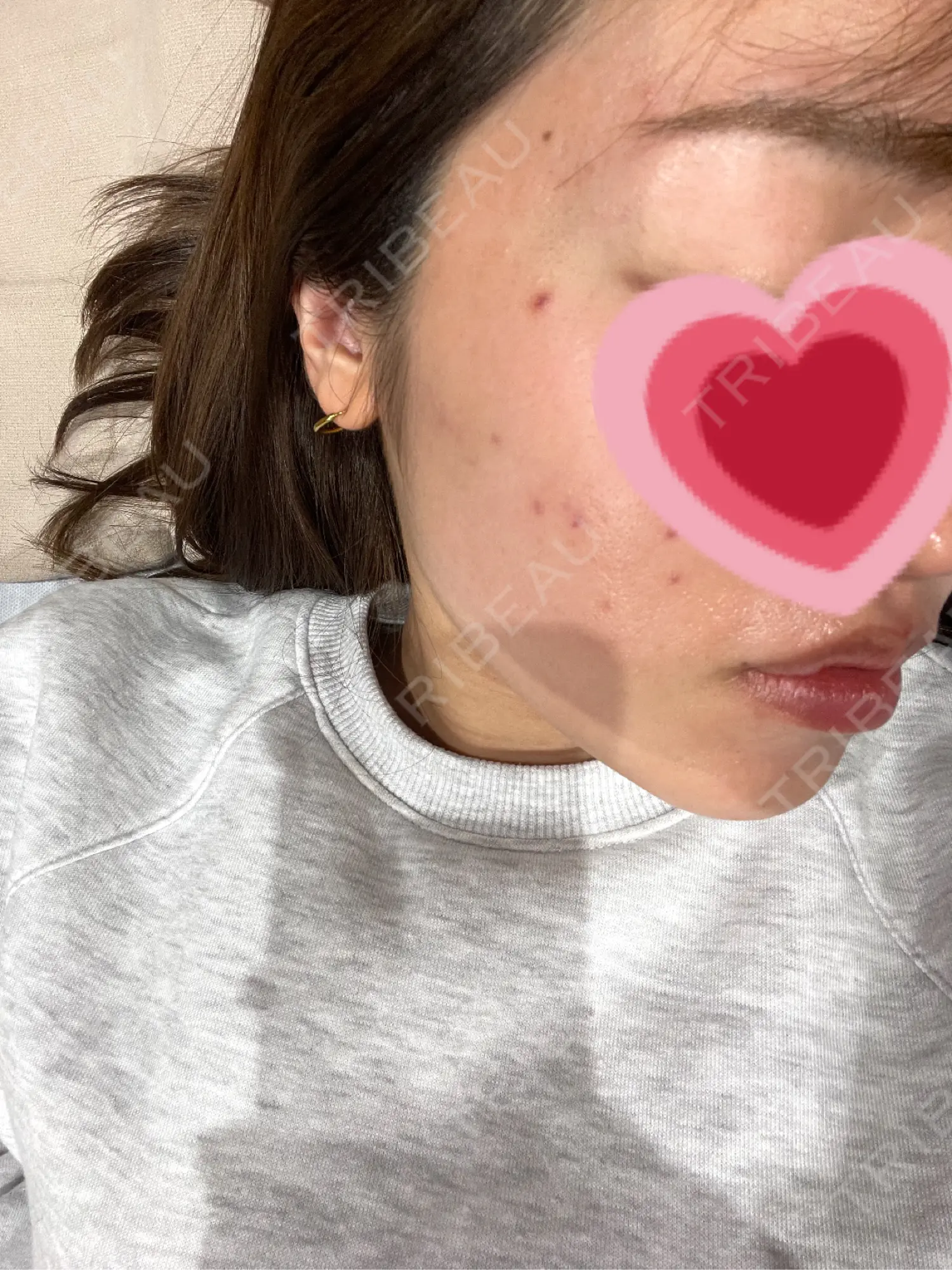 施術前の写真