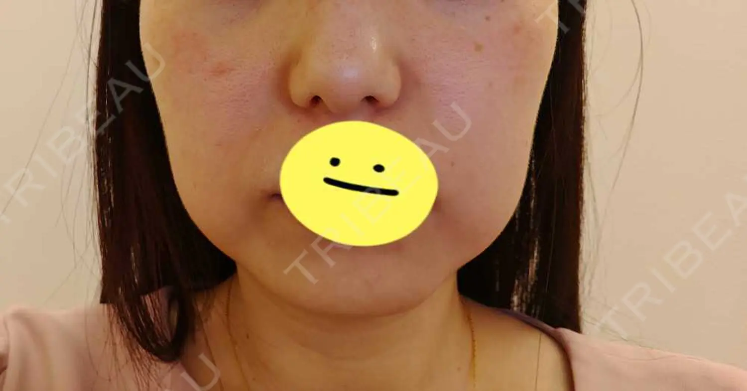 施術前の写真