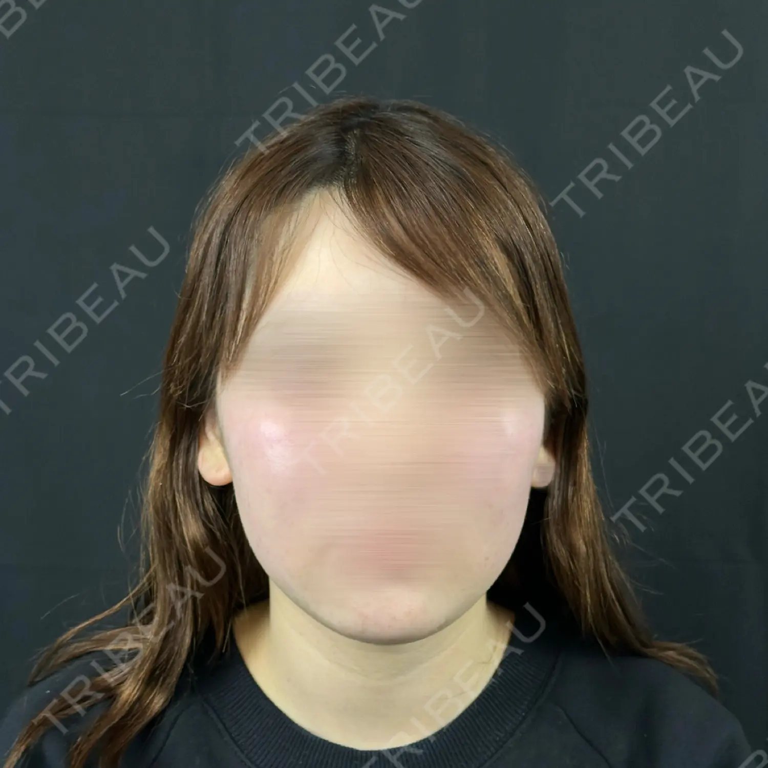 施術前の写真