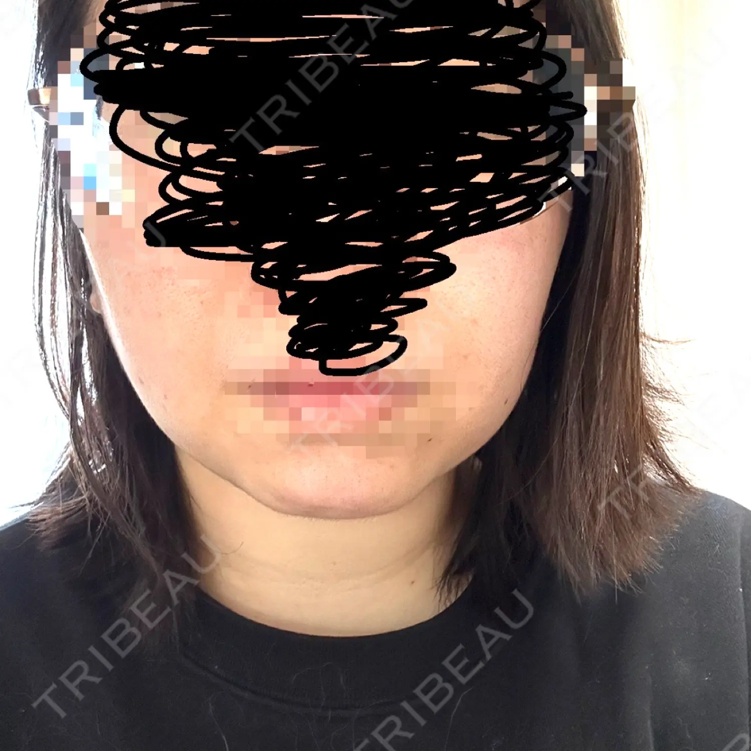 施術前の写真
