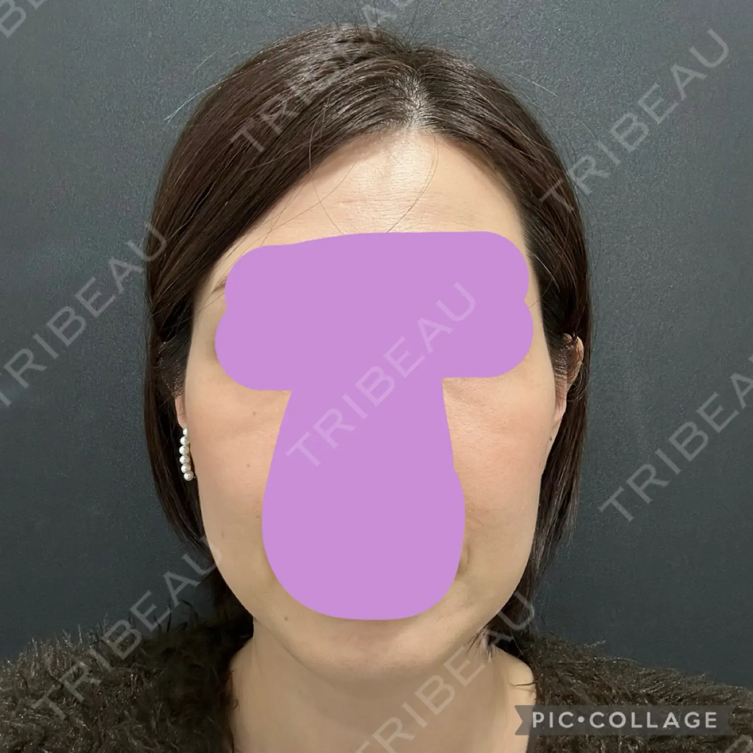 施術前の写真