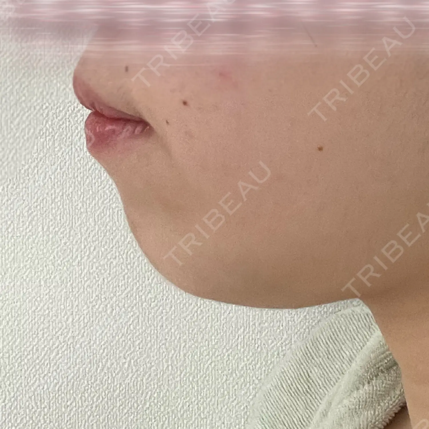 施術前の写真