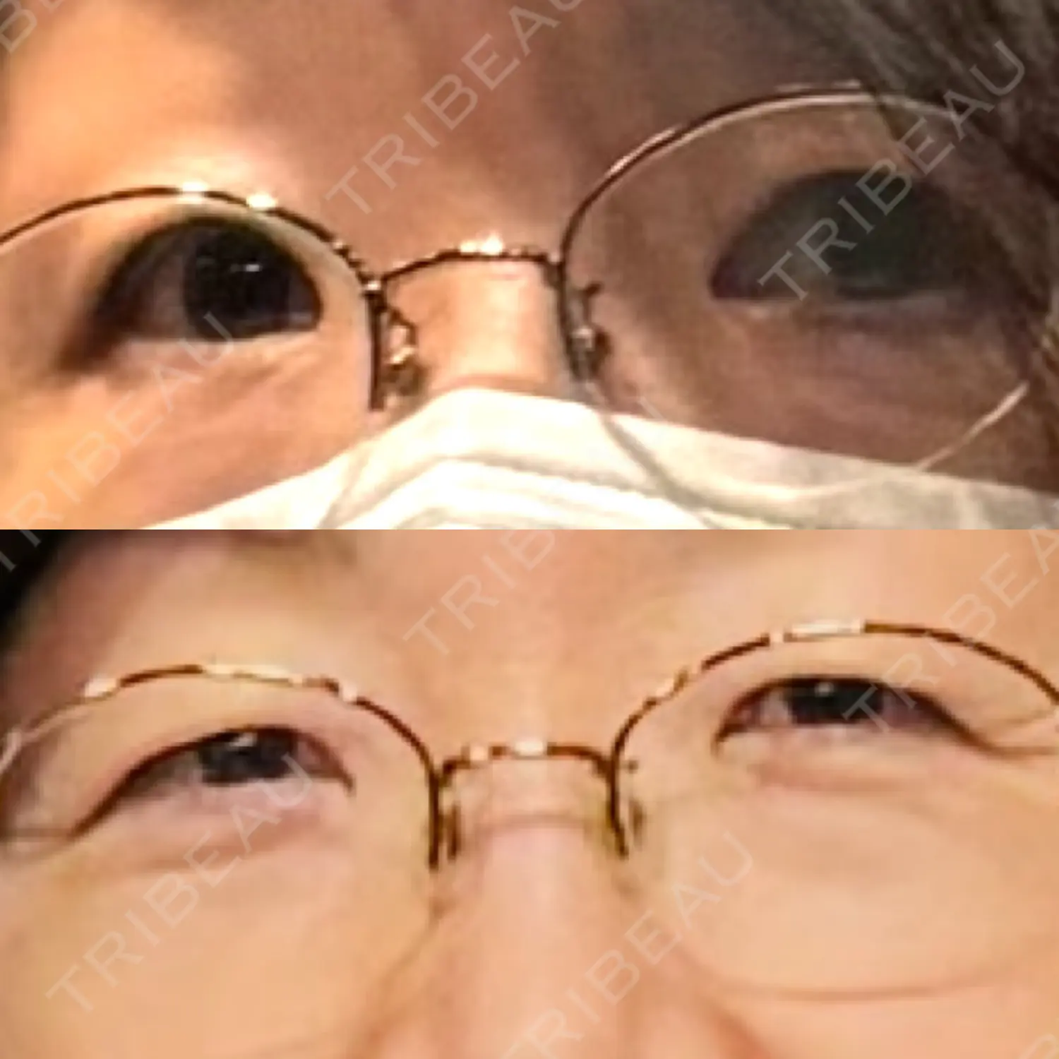 施術前の写真