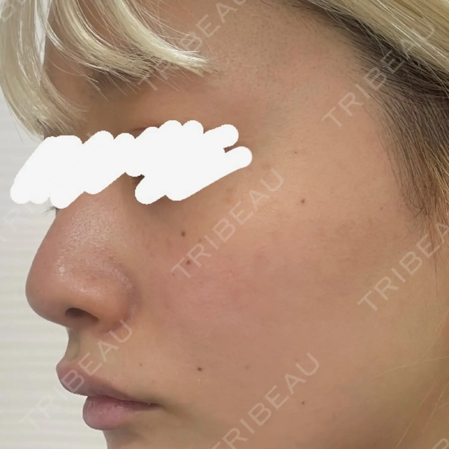 施術前の写真