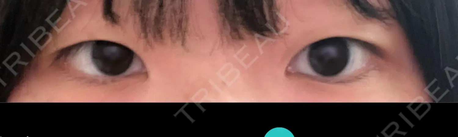 施術前の写真