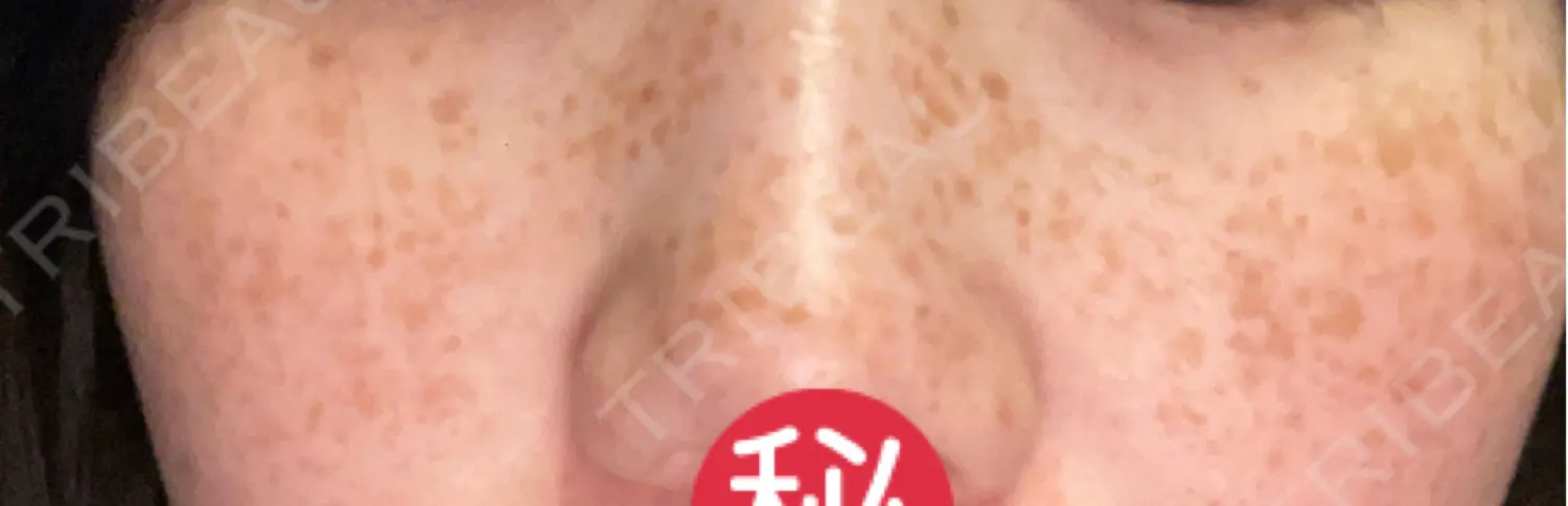 施術前の写真