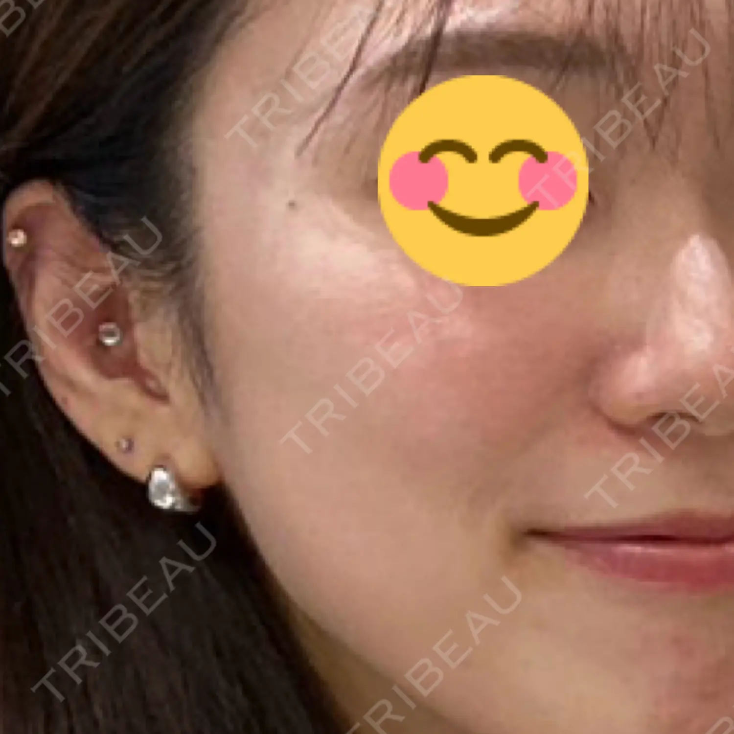 施術前の写真