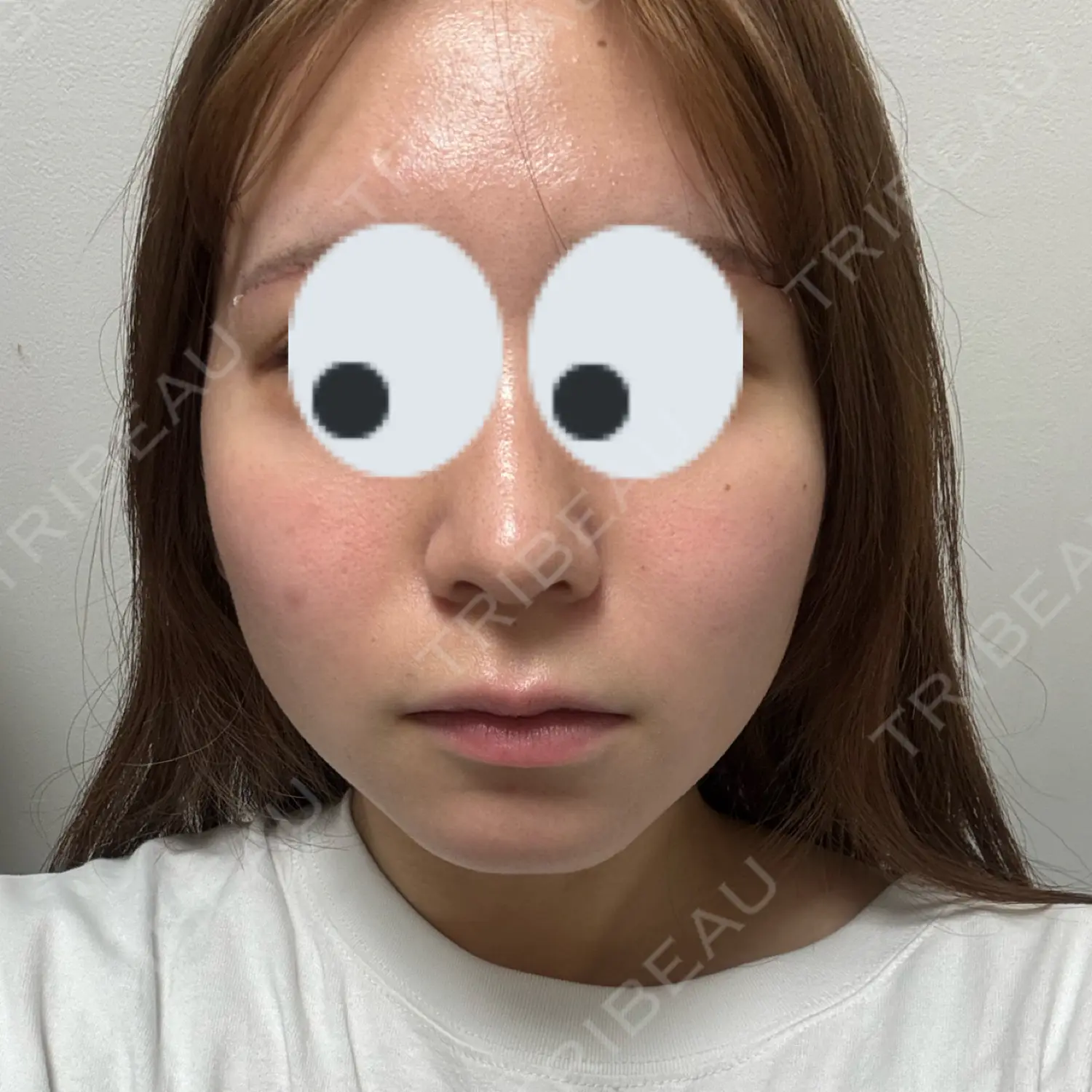 施術前の写真
