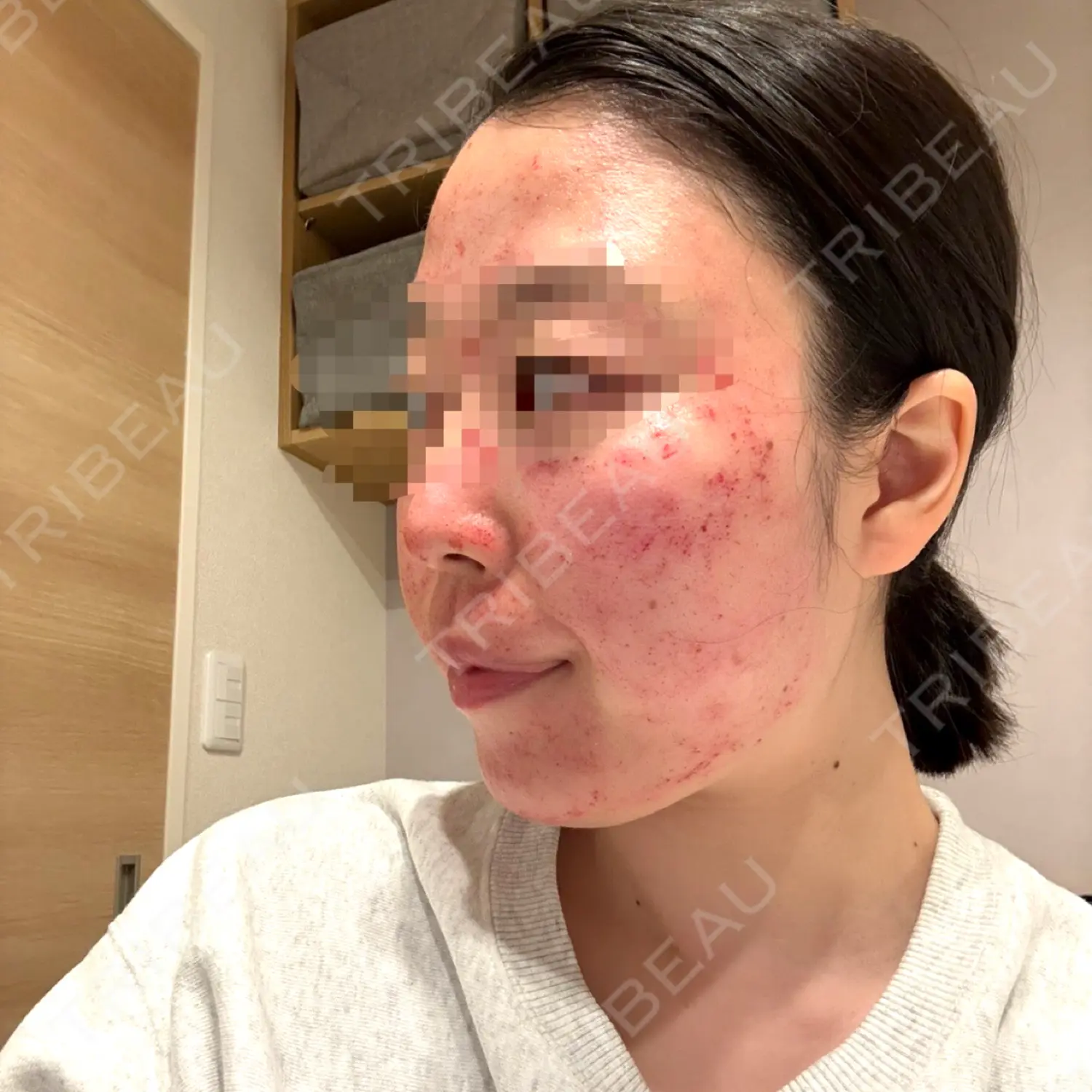 施術前の写真