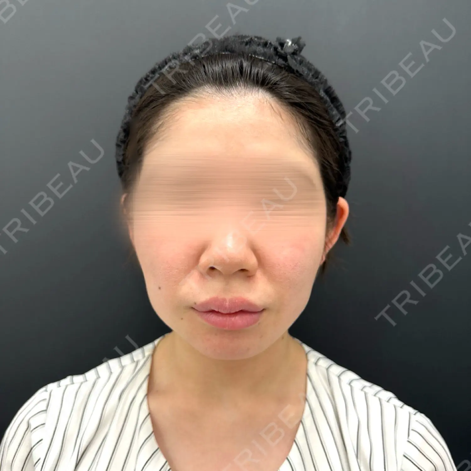 施術前の写真