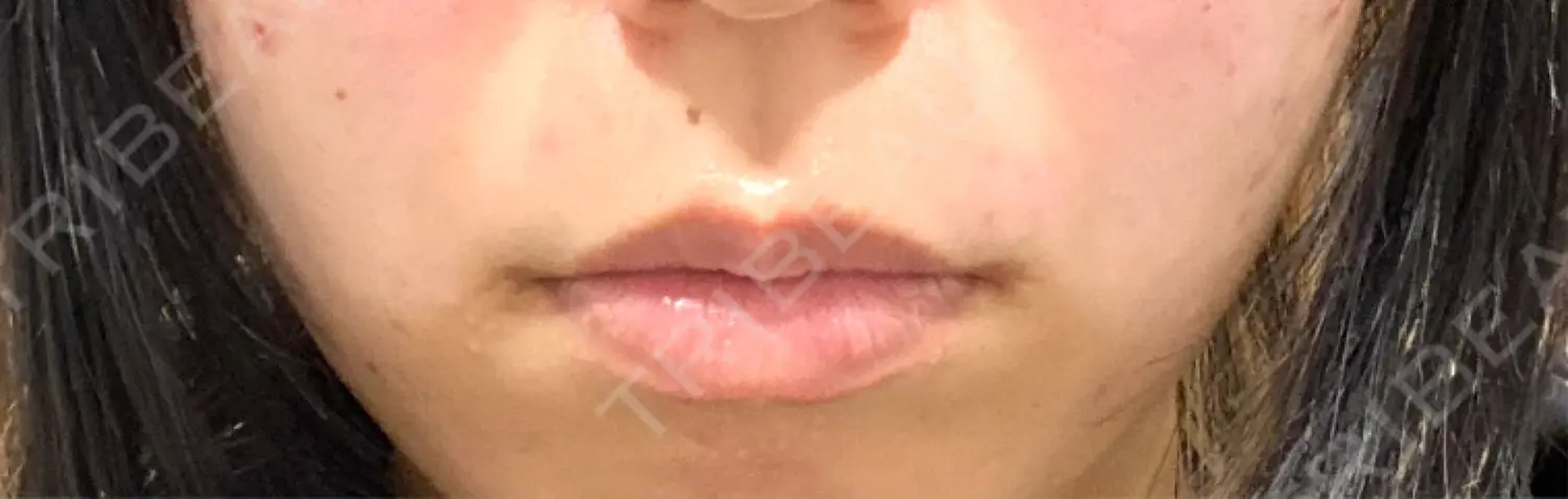 施術前の写真