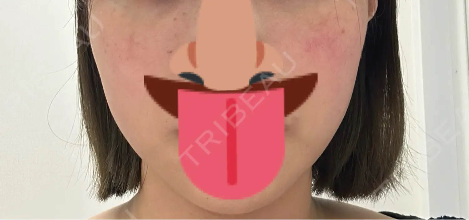 施術前の写真