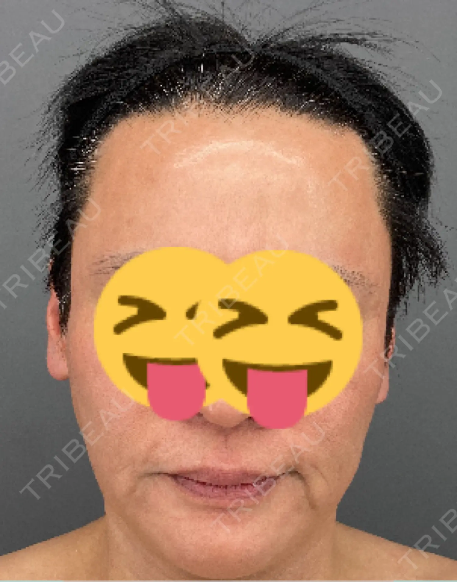 施術前の写真