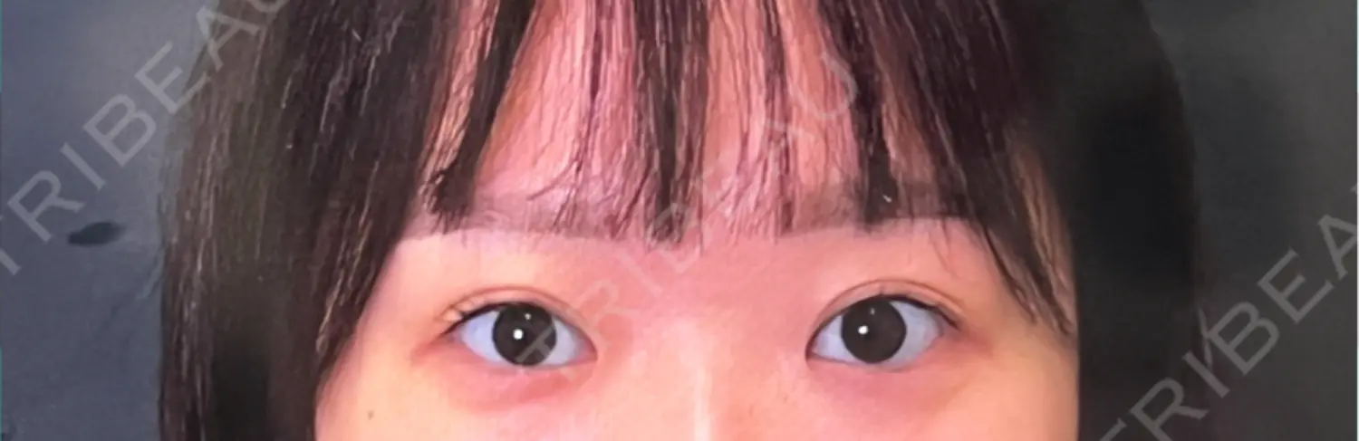 施術前の写真