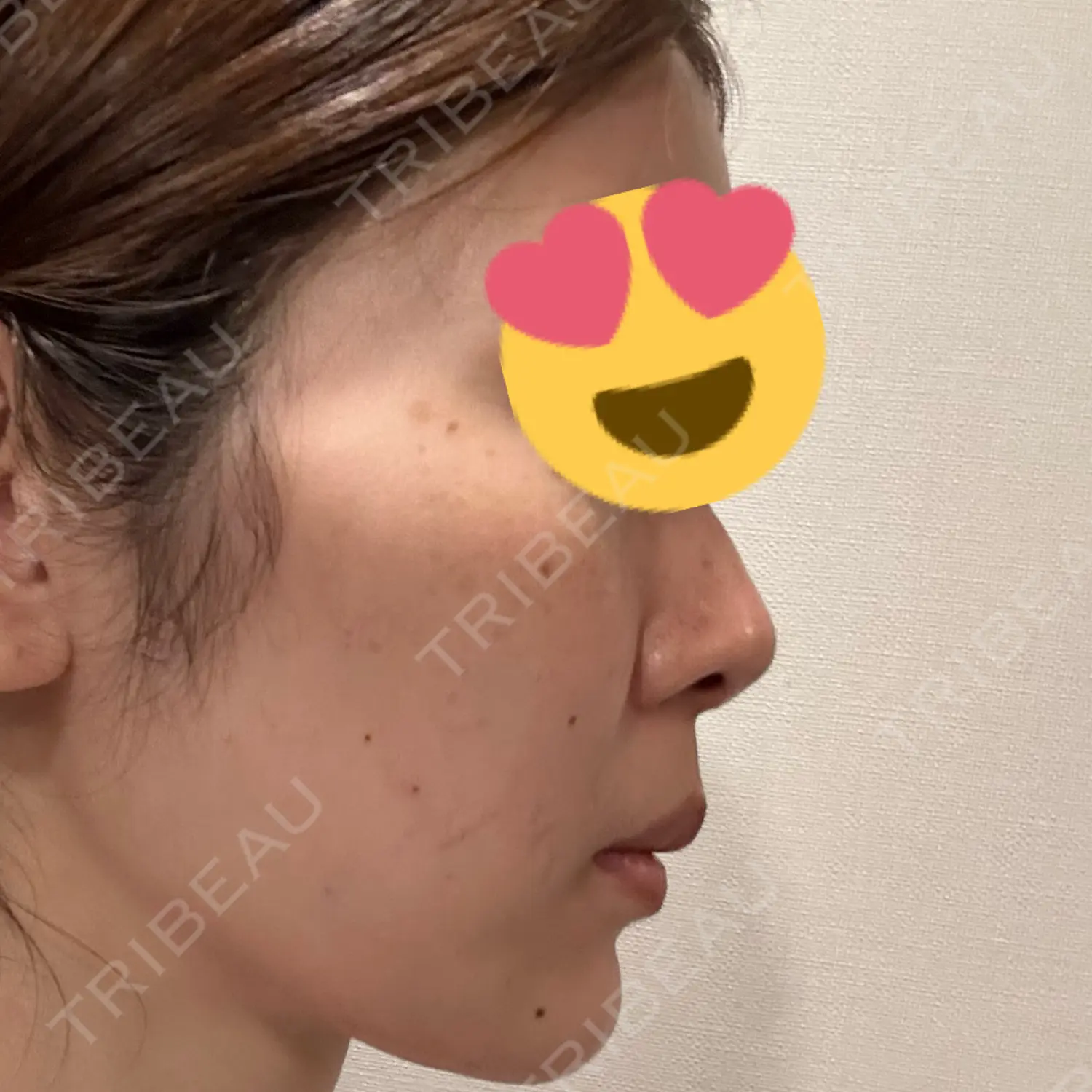 施術前の写真
