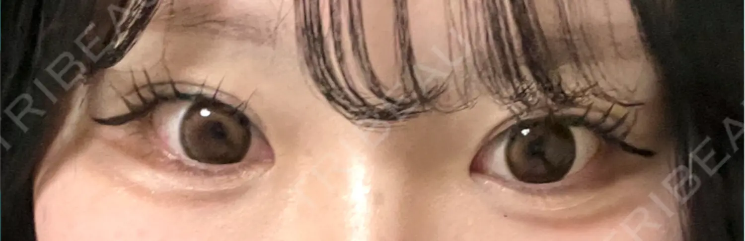 施術前の写真