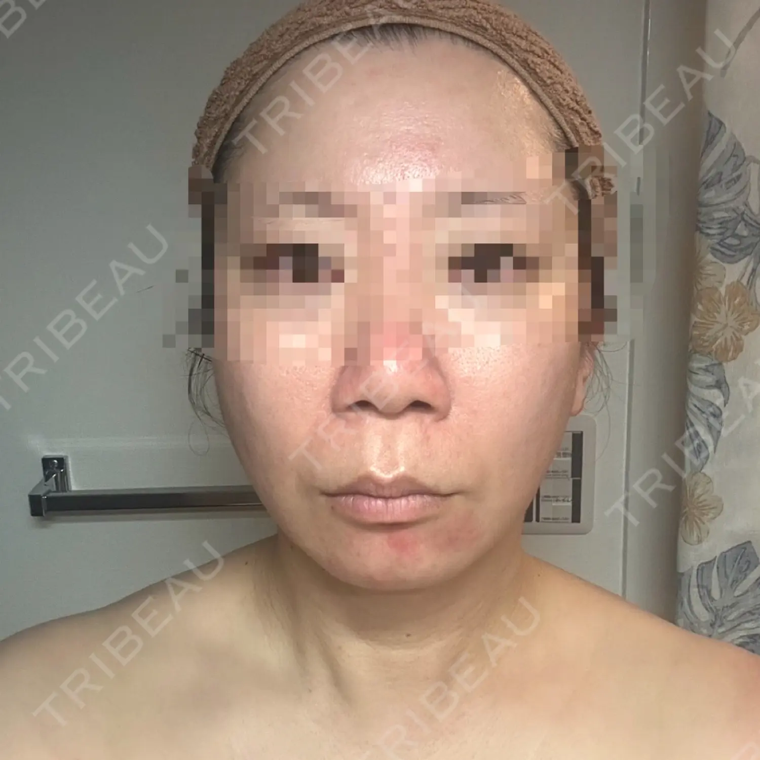 施術前の写真