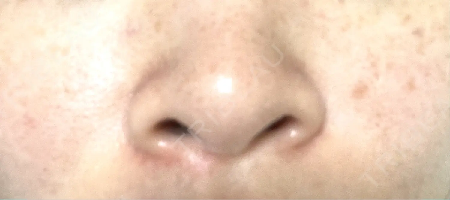 施術前の写真