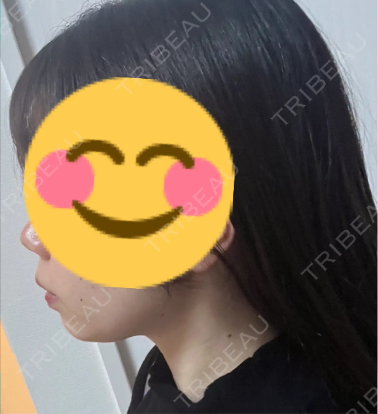施術前の写真