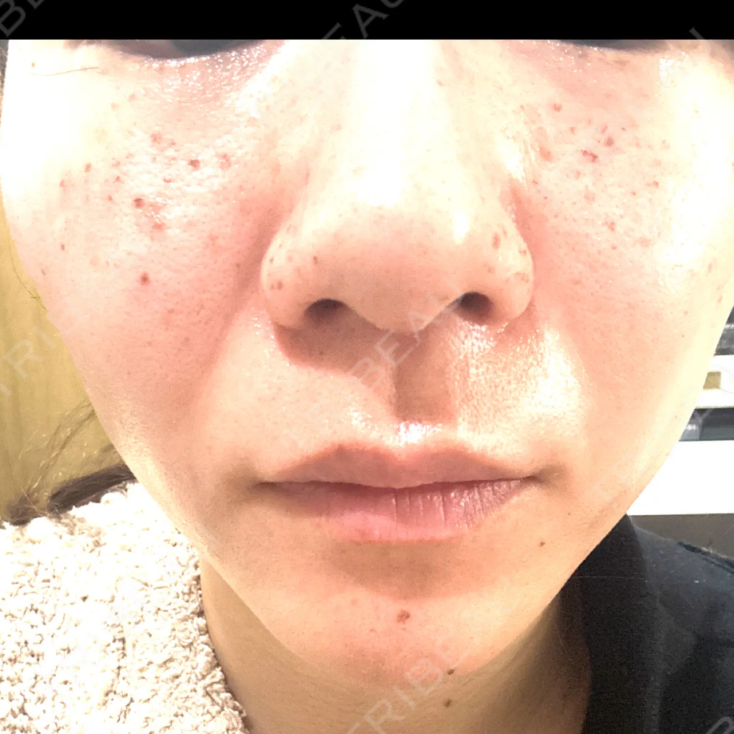 施術前の写真