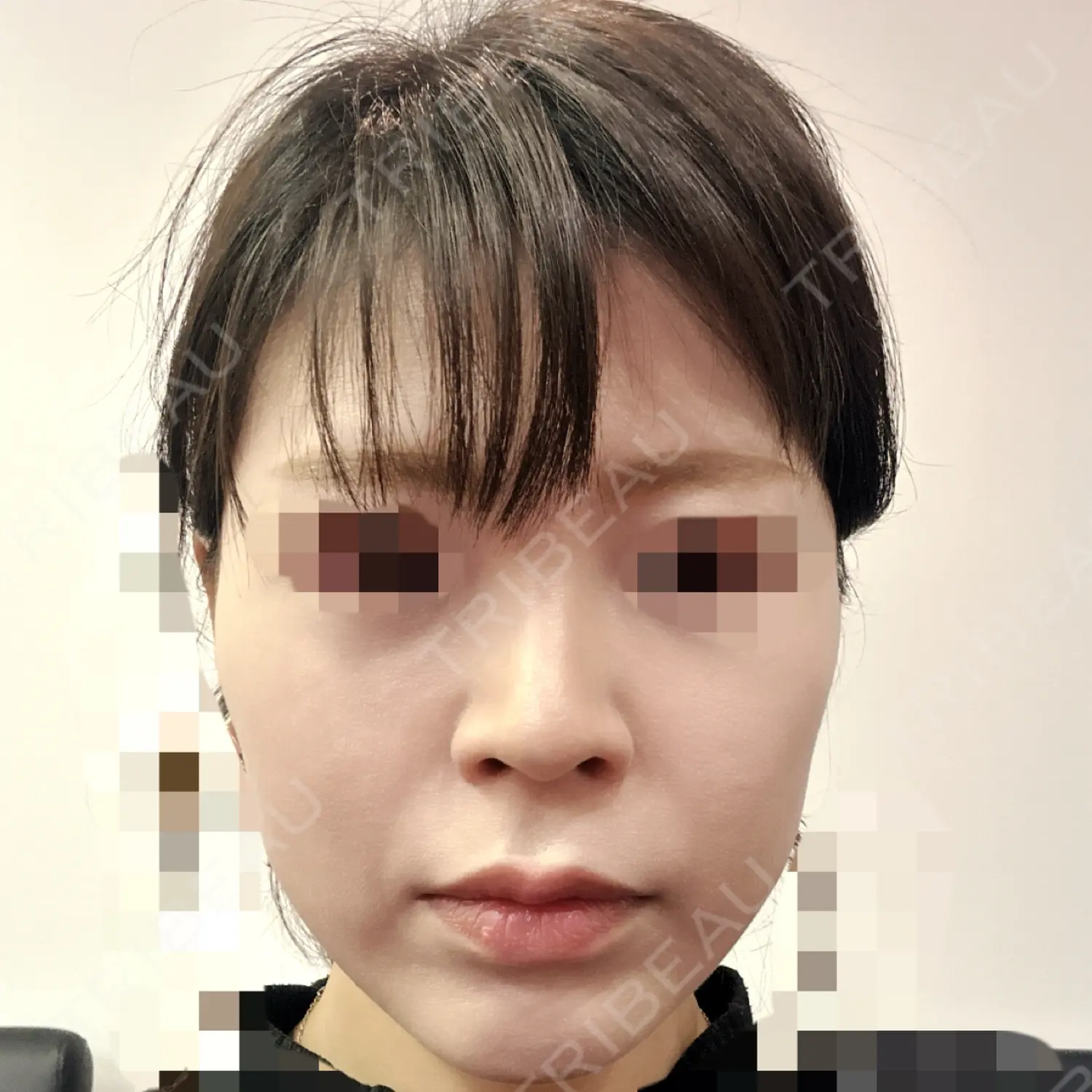 施術前の写真
