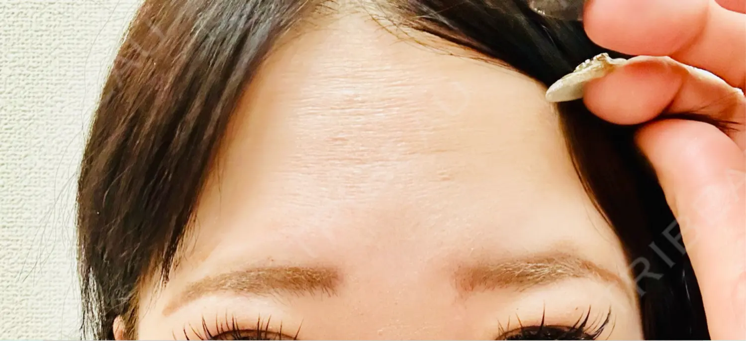 施術前の写真