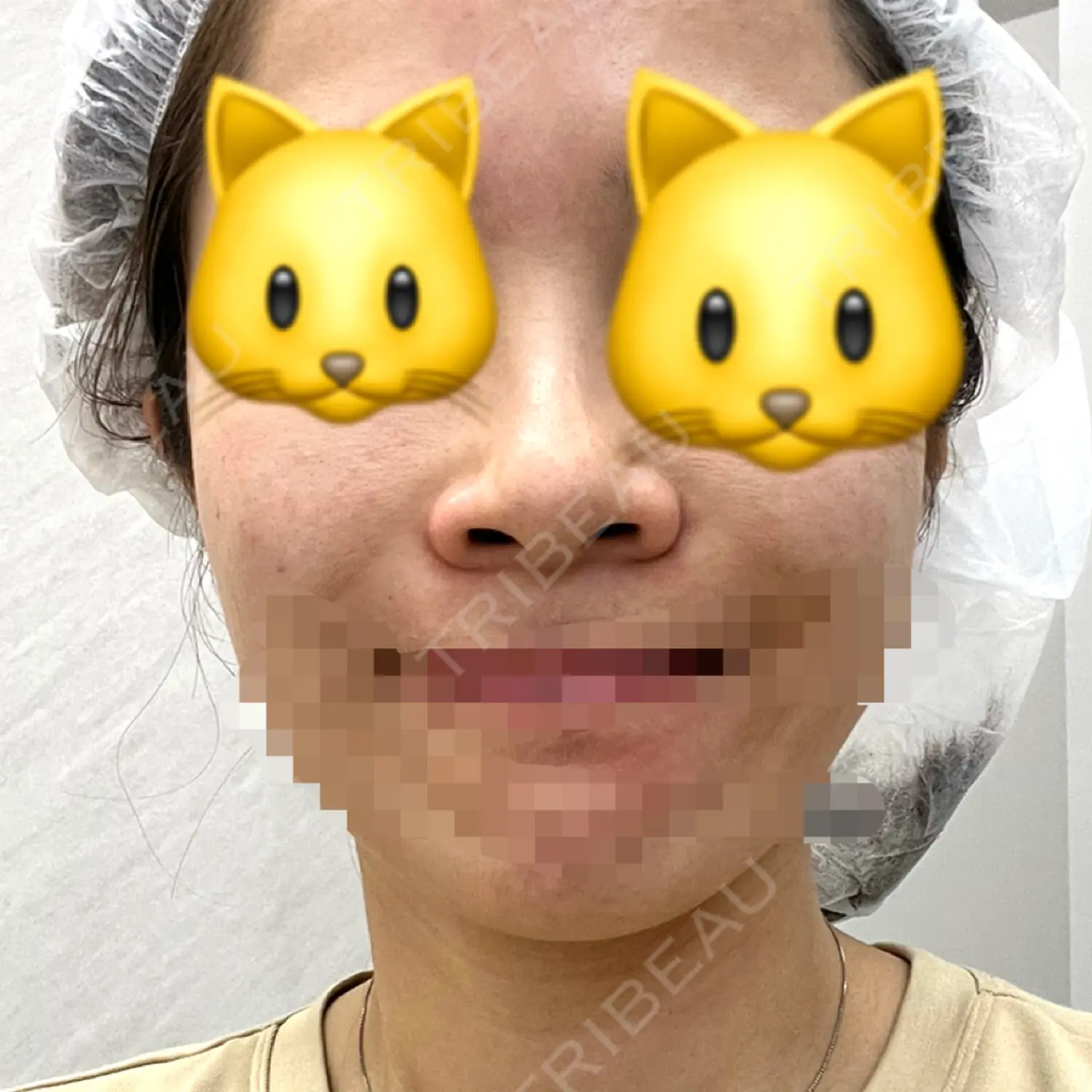 施術前の写真