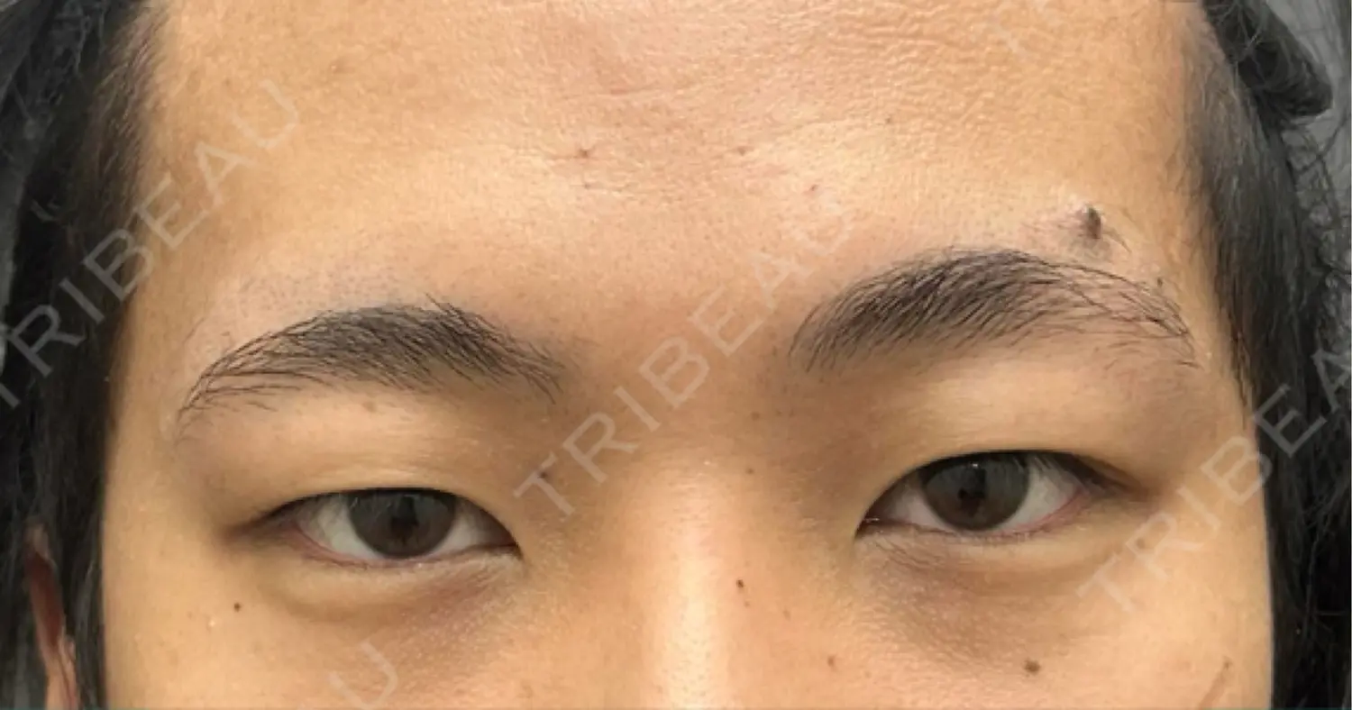 施術前の写真