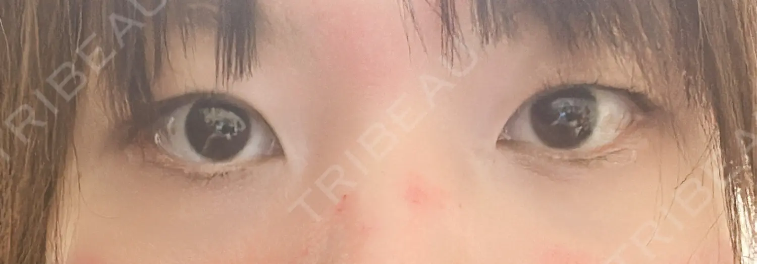 施術前の写真