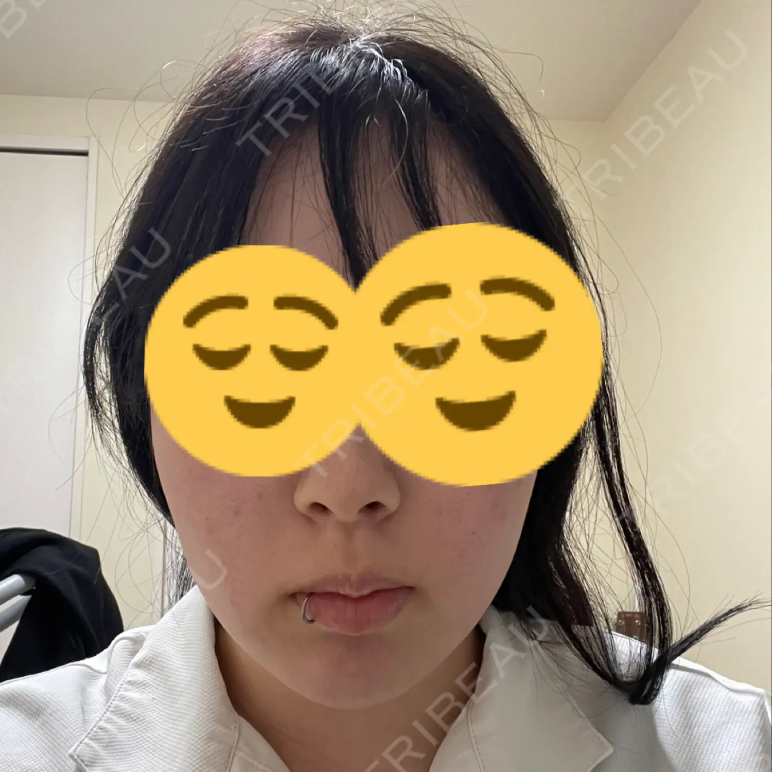施術前の写真