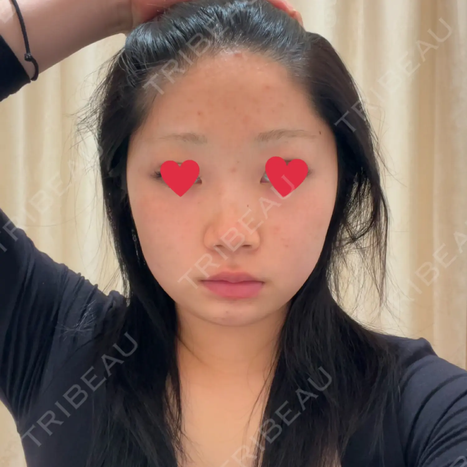 施術前の写真