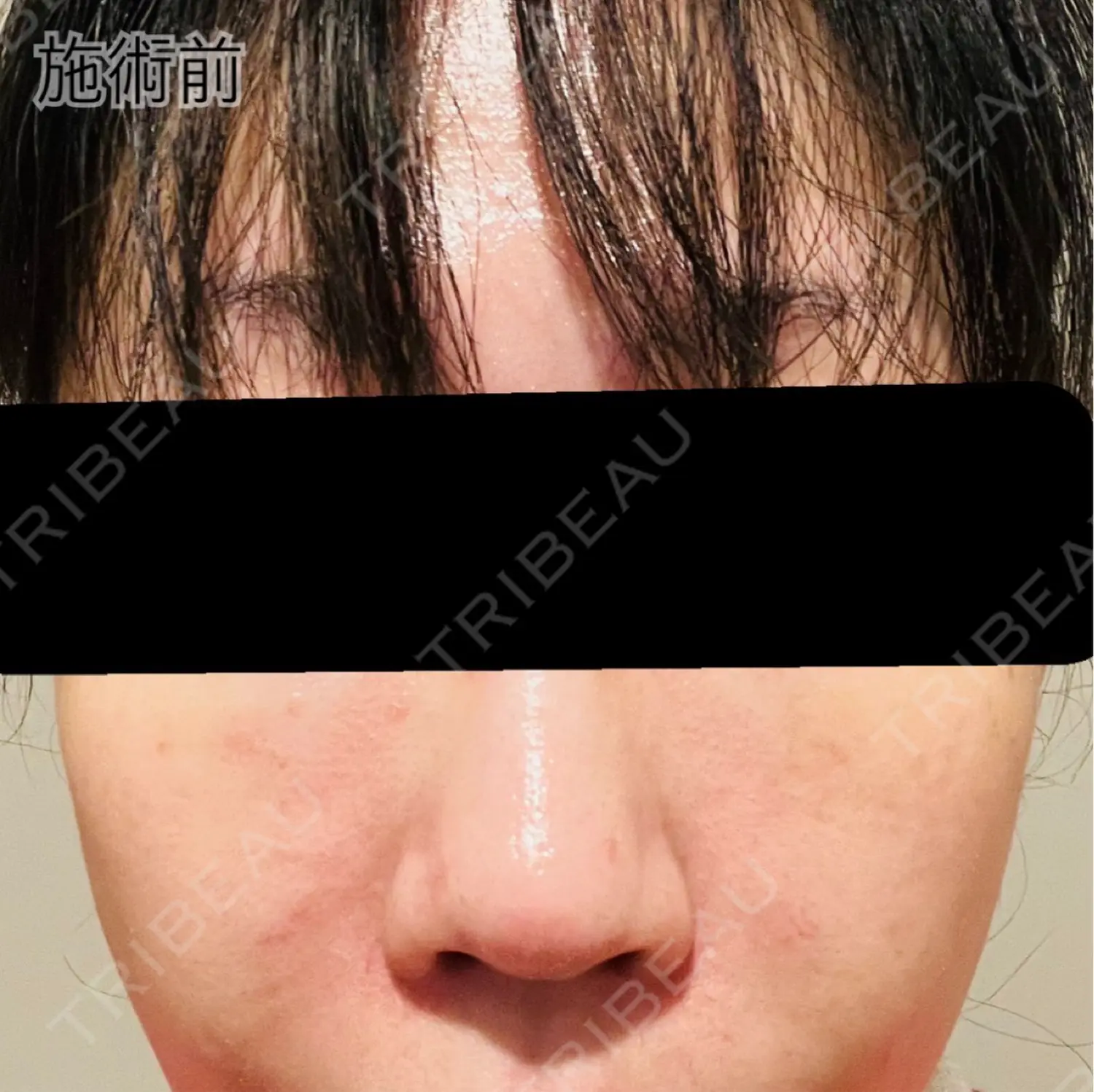 施術前の写真