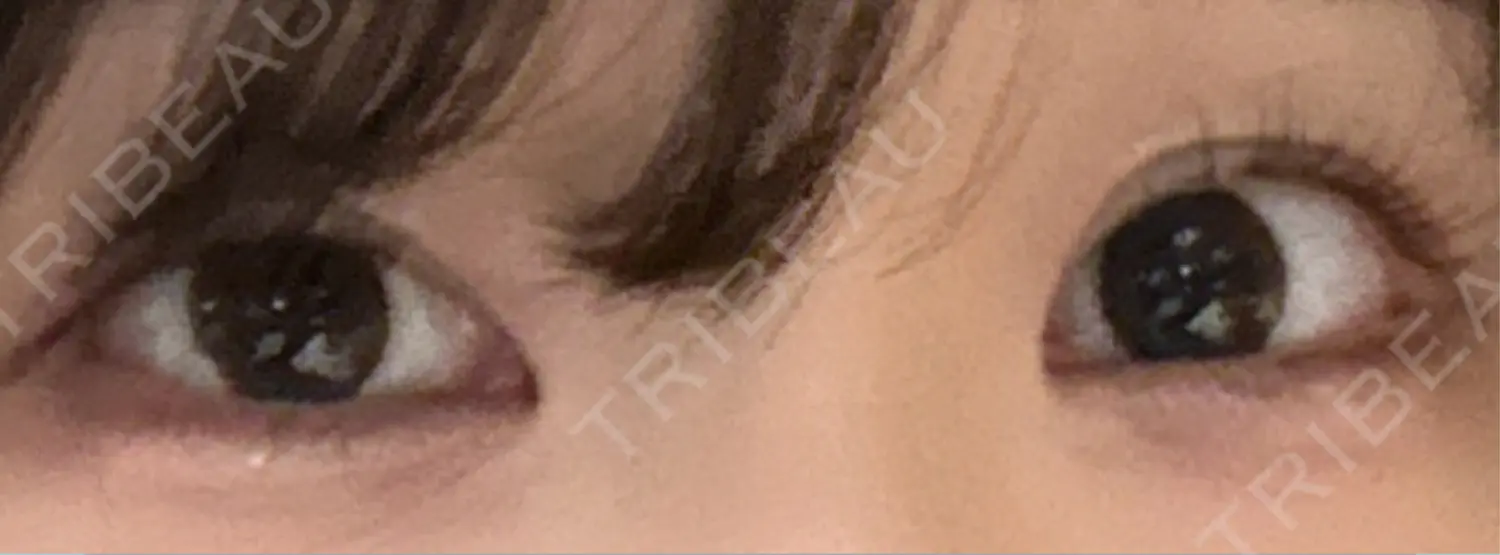 施術前の写真