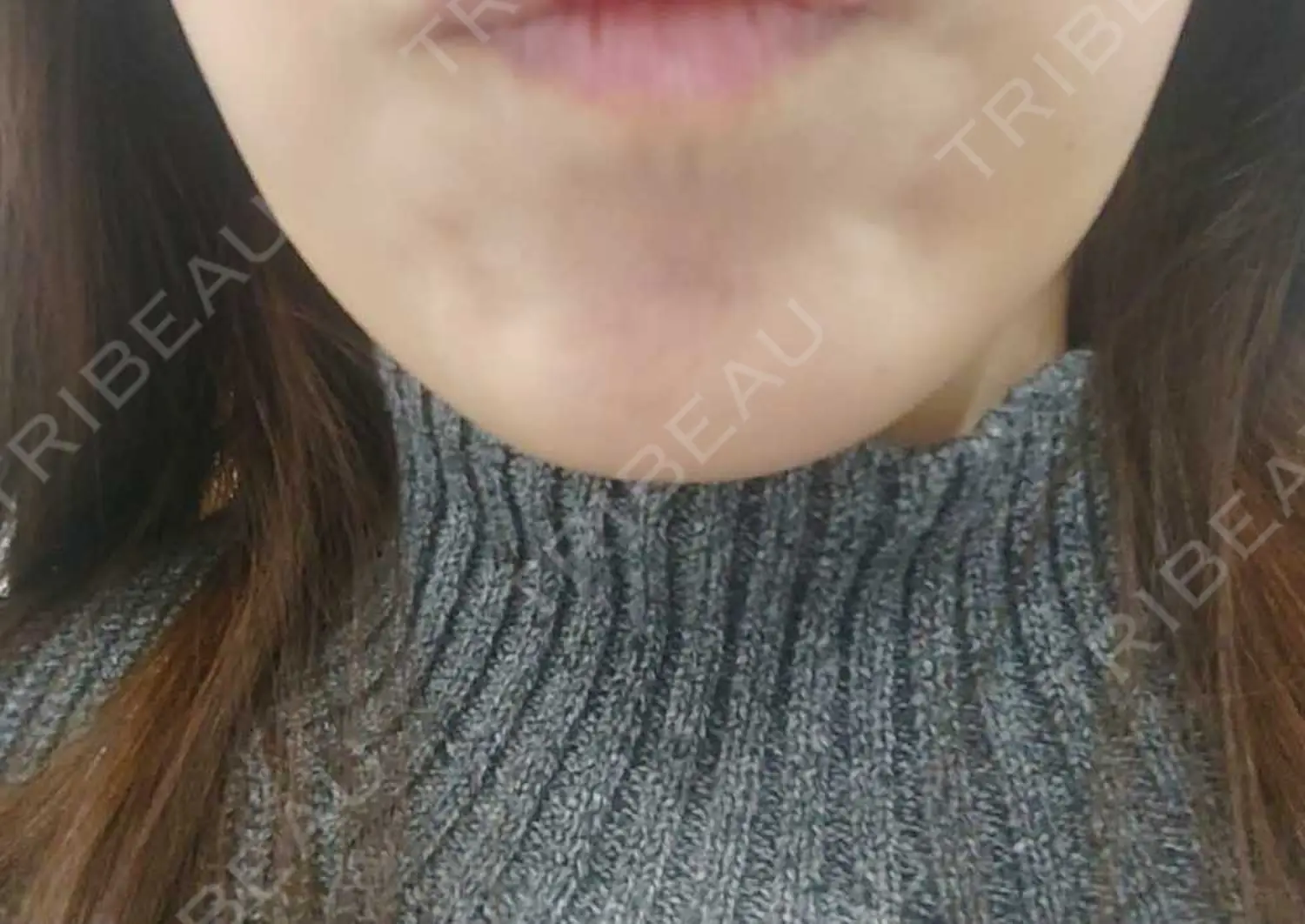 施術前の写真