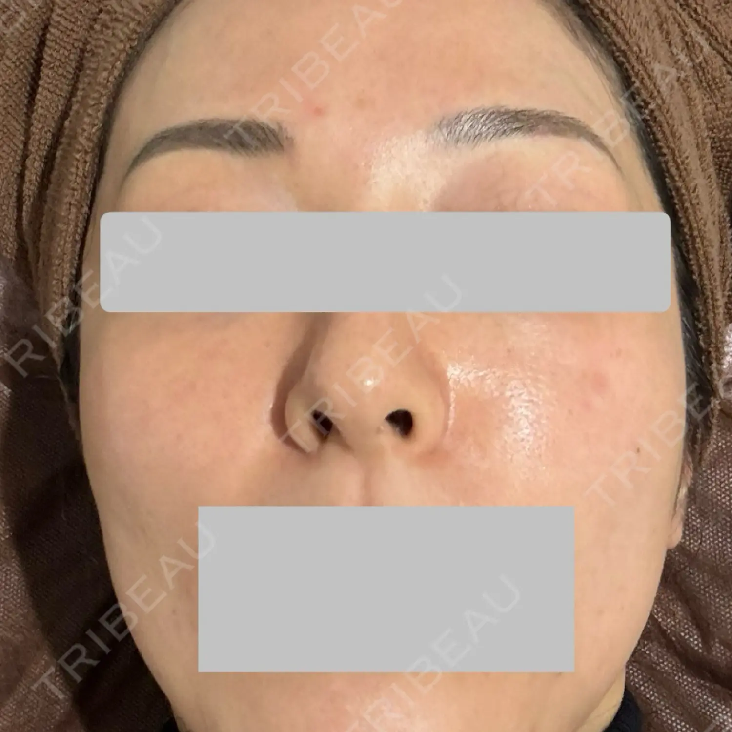 施術前の写真