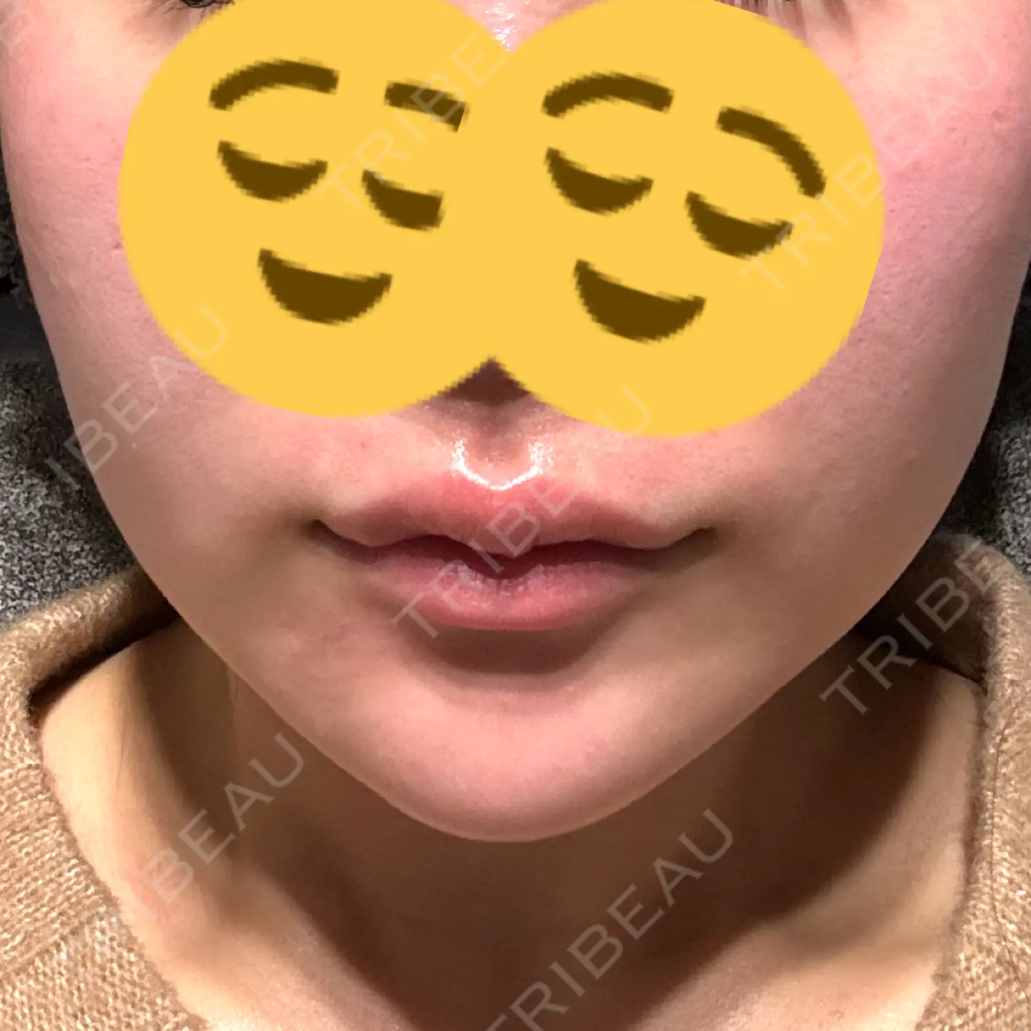 施術前の写真