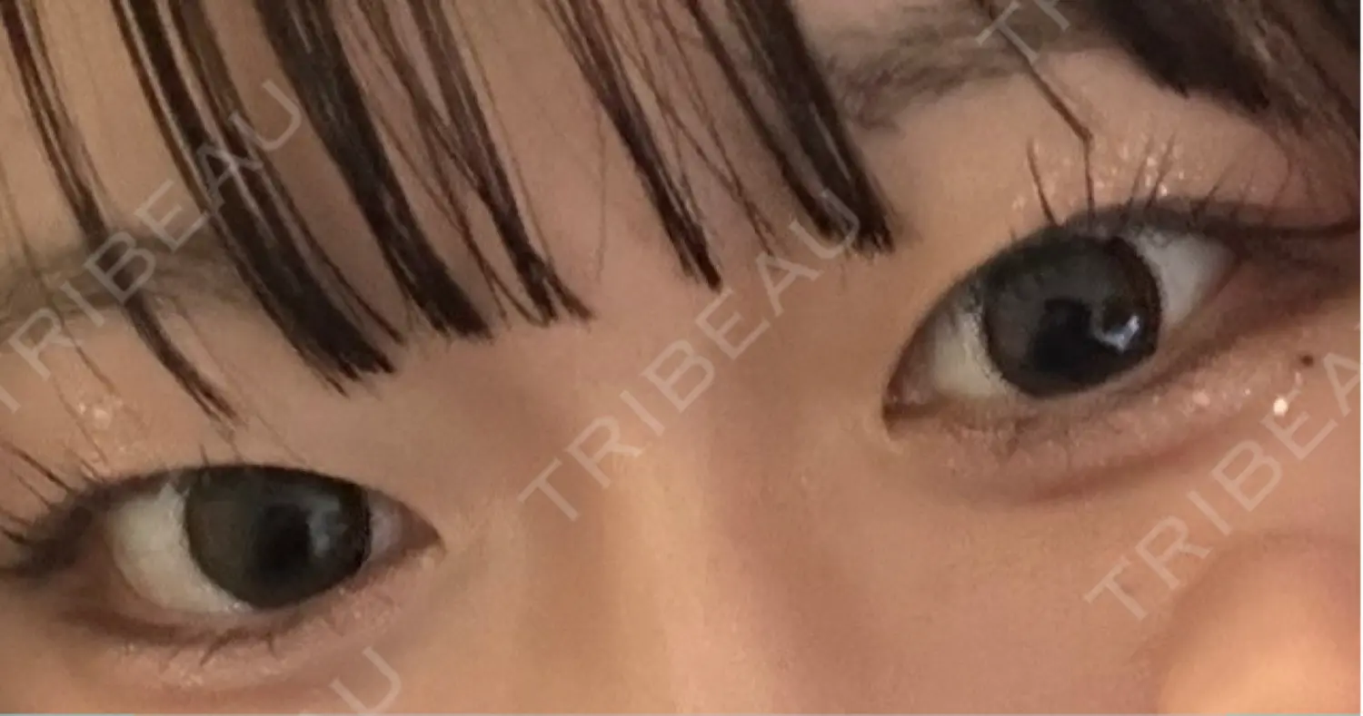 施術前の写真