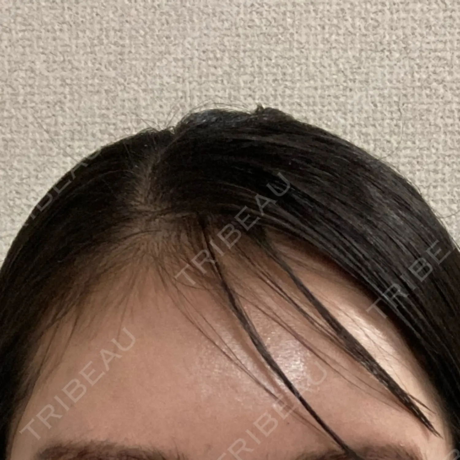 施術前の写真