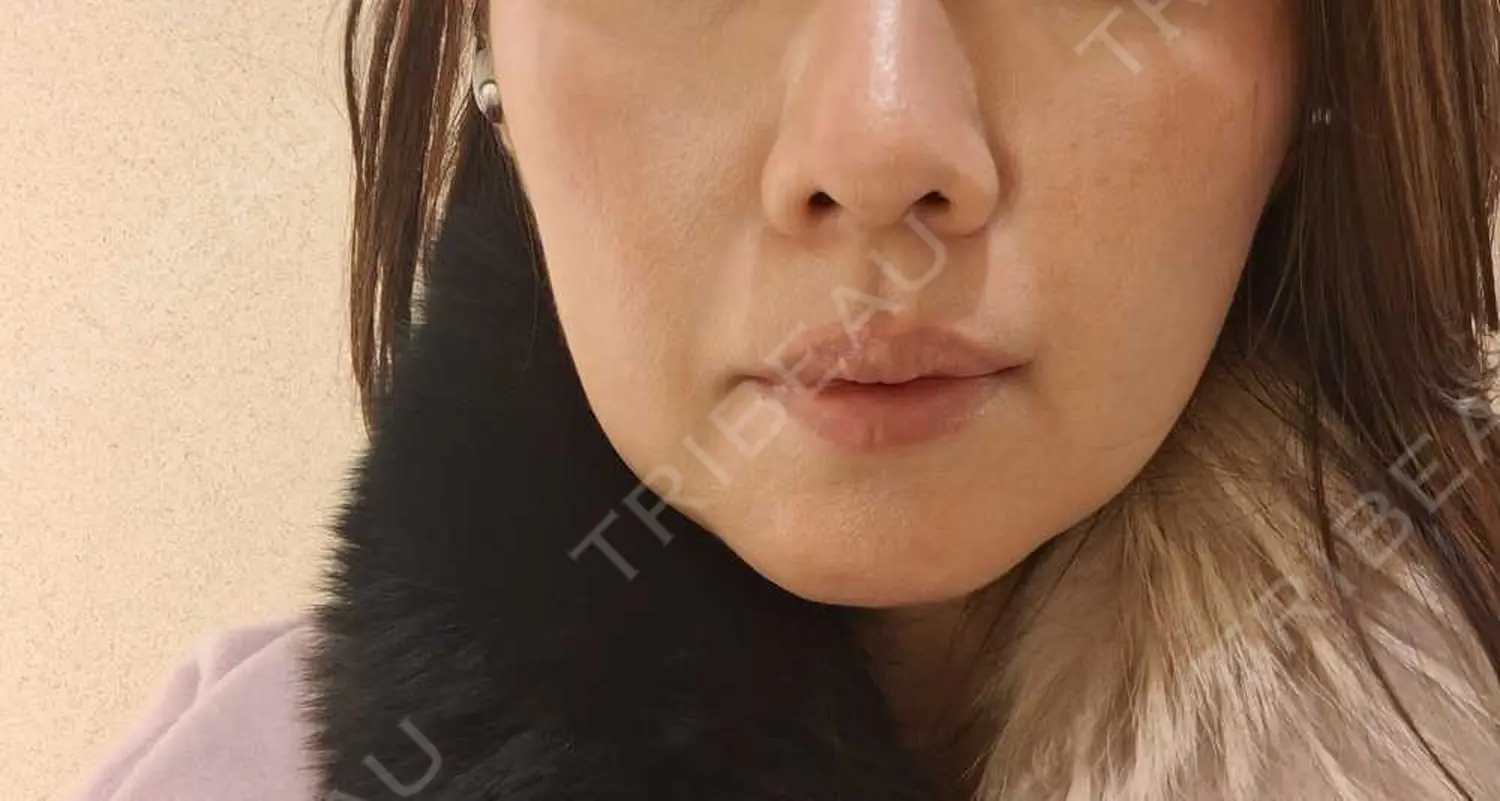 施術前の写真