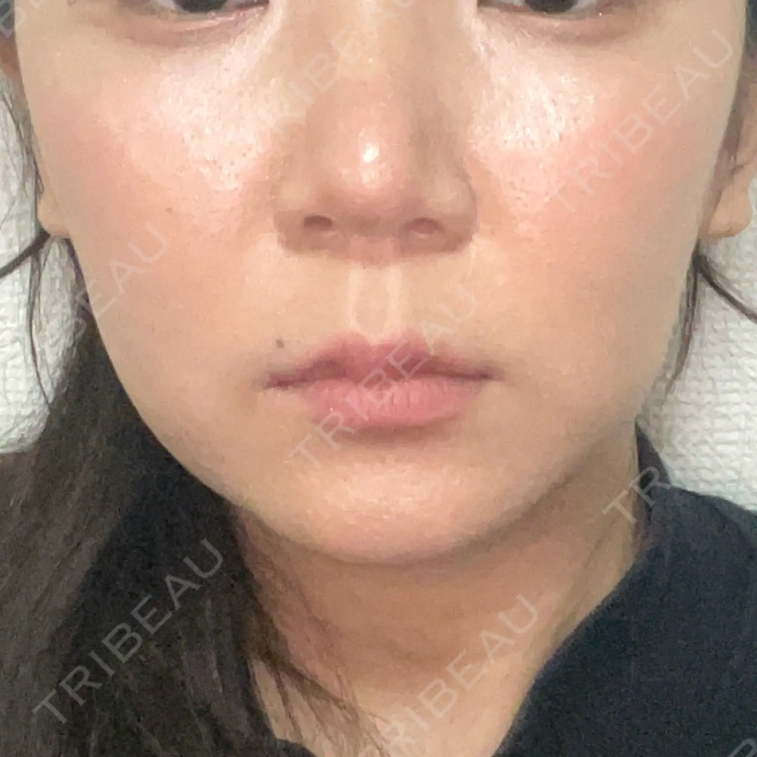 施術前の写真