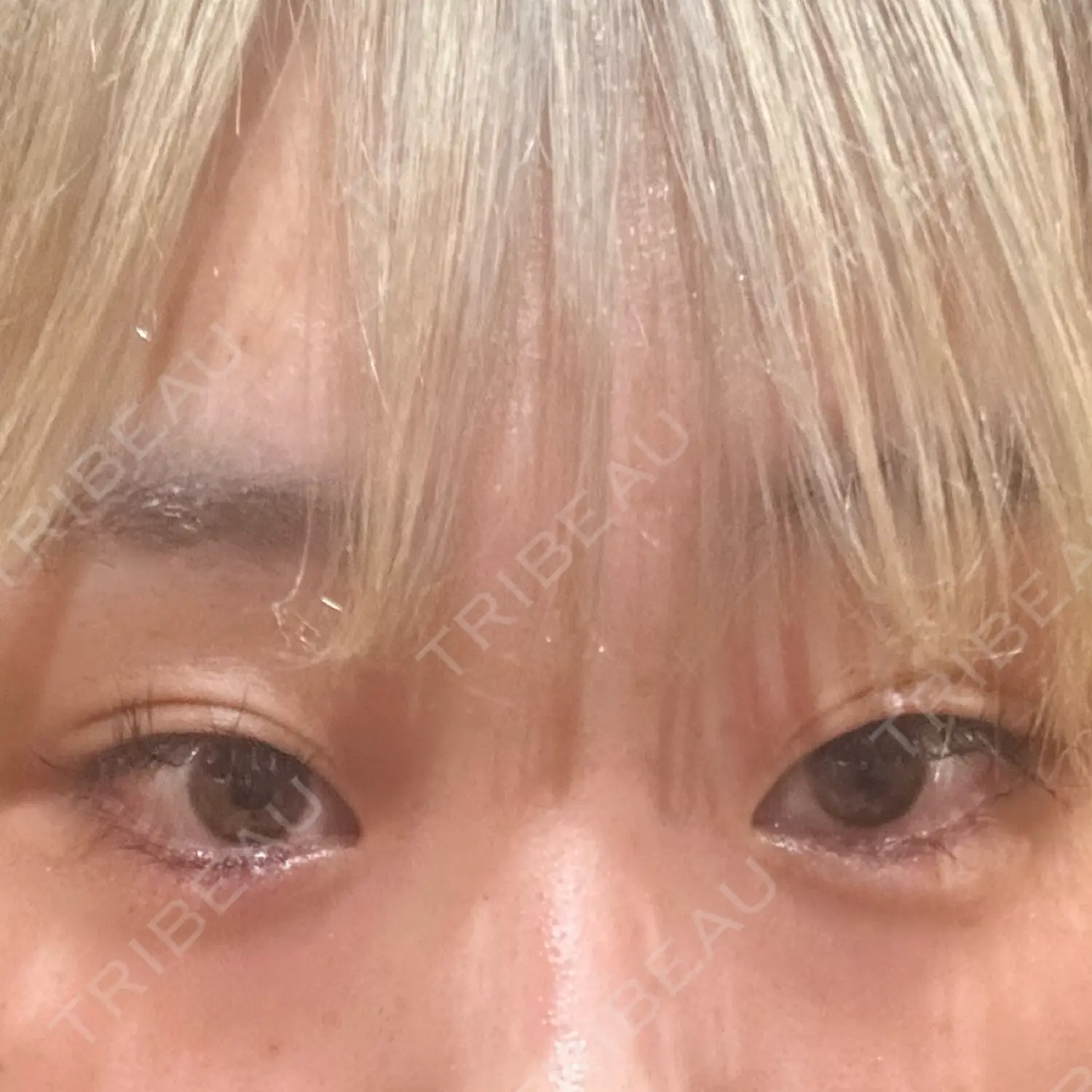 施術前の写真